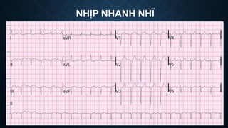 NHỊP NHANH NHĨ
 