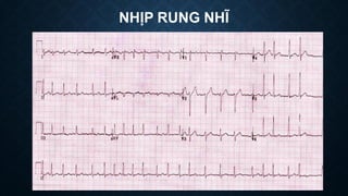 NHỊP RUNG NHĨ
 