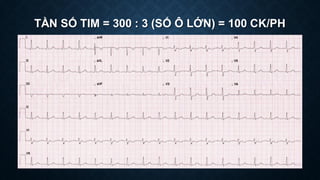 TẦN SỐ TIM = 300 : 3 (SỐ Ô LỚN) = 100 CK/PH
 