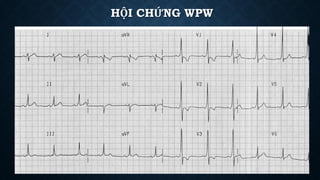 HỘI CHỨNG WPW
 