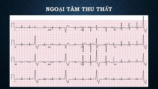 NGOẠI TÂM THU THẤT
 