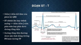 ĐOẠN ST - T
• Điểm J: điểm kết thúc của
phức bộ QRS
• ST chênh lên hay chênh
xuống -> điểm điểm J nằm
phía trên hay phía dưới
đường đẳng điện
• Đường đẳng điện thường
được xác định bằng đường
PR hoặc đường TP
 