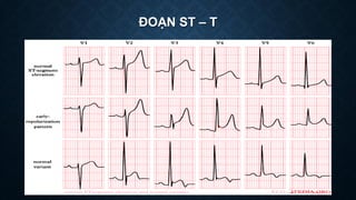ĐOẠN ST – T
 