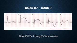 ĐOẠN ST – SÓNG T
Thay đổi ST – T trong Nhồi máu cơ tim
 