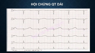 HỘI CHỨNG QT DÀI
 