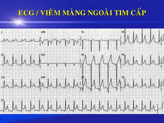 ECG / VIEÂM MAØNG NGOAØI TIM CAÁP
 