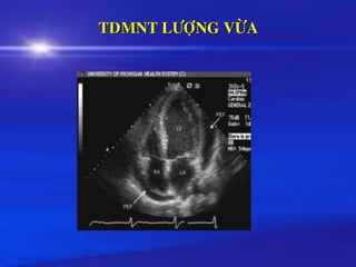 TDMNT LÖÔÏNG VÖØA
 