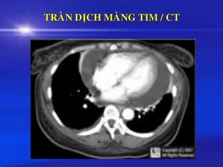 TRAØN DÒCH MAØNG TIM / CT
 