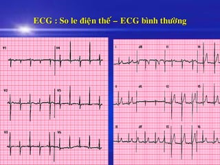ECG : So le ñieän theá – ECG bình thöôøng
 