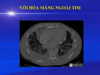 VOÂI HOÙA MAØNG NGOAØI TIM
 