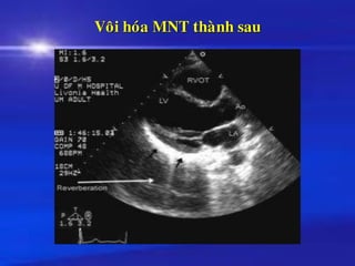 Voâi hoùa MNT thaønh sau
 