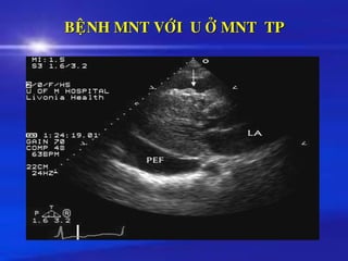 BEÄNH MNT VÔÙI U ÔÛ MNT TP
 