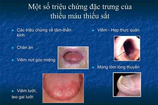  Viêm - Hẹp thực quản
 Móng lõm lòng thuyền
Một số triệu chứng đặc trưng của
thiếu máu thiếu sắt
 Các triệu chứng về tâm-thần
kinh
 Chán ăn
 Viêm nứt góc miệng
 Viêm lưỡi,
teo gai lưỡi
 