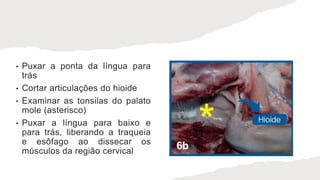 • Puxar a ponta da língua para
trás
• Cortar articulações do hioide
• Examinar as tonsilas do palato
mole (asterisco)
• Puxar a língua para baixo e
para trás, liberando a traqueia
e esôfago ao dissecar os
músculos da região cervical
 