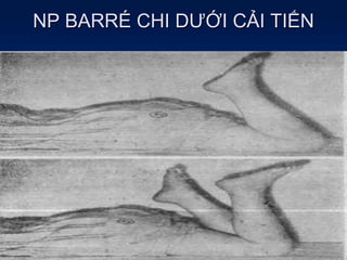 NP BARRÉ CHI DƯỚI CẢI TIẾN
 