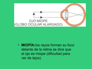 • MIOPÍA:los rayos forman su foco
delante de la retina se dice que
el ojo es miope (dificultad para
ver de lejos)
 