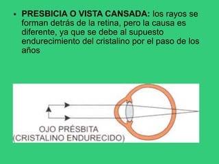 • PRESBICIA O VISTA CANSADA: los rayos se
forman detrás de la retina, pero la causa es
diferente, ya que se debe al supuesto
endurecimiento del cristalino por el paso de los
años
 