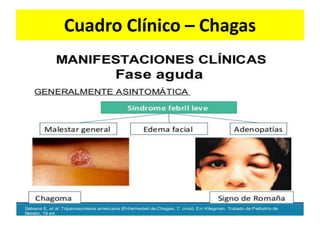 Cuadro Clínico – Chagas
 