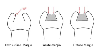 Cavosurface Margin Acute margin Obtuse Margin
 