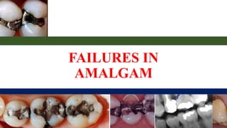 FAILURES IN
AMALGAM
 