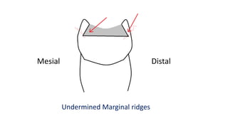 Mesial Distal
Undermined Marginal ridges
 