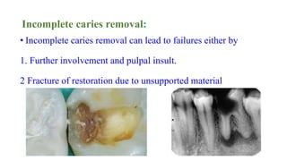 Incomplete caries removal:
• Incomplete caries removal can lead to failures either by
1. Further involvement and pulpal insult.
2 Fracture of restoration due to unsupported material
 