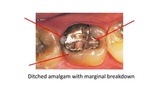 Ditched amalgam with marginal breakdown
 