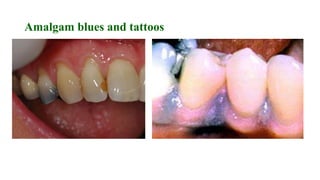 Amalgam blues and tattoos
 