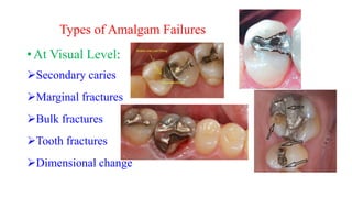 Types of Amalgam Failures
• At Visual Level:
Secondary caries
Marginal fractures
Bulk fractures
Tooth fractures
Dimensional change
 
