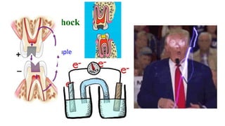 Galvanic Shock
• The electric couple
(500 millivolts) created when the
two restorations touch causes
sharp pain called ‘galvanic shock’
 