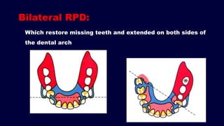 The Dual Path Rpd 1. Introduction and forces acting on Removable Partial Denture (RPD ...