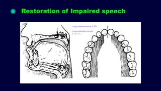 1. Introduction and forces acting on Removable Partial Denture (RPD ...