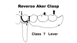 1. Introduction and forces acting on Removable Partial Denture (RPD ...