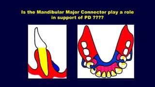 Beading Rpd 1. Introduction and forces acting on Removable Partial Denture (RPD ...