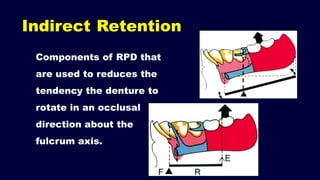 1. Introduction and forces acting on Removable Partial Denture (RPD ...