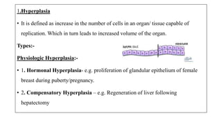 1.Hyperplasia
• It is defined as increase in the number of cells in an organ/ tissue capable of
replication. Which in turn leads to increased volume of the organ.
Types:-
Physiologic Hyperplasia:-
• 1. Hormonal Hyperplasia- e.g. proliferation of glandular epithelium of female
breast during puberty/pregnancy.
• 2. Compensatory Hyperplasia – e.g. Regeneration of liver following
hepatectomy
 
