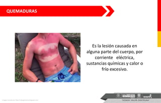 QUEMADURAS
Imagen tomada de: http://cabuginoticia.blogspot.com
Es la lesión causada en
alguna parte del cuerpo, por
corriente eléctrica,
sustancias químicas y calor o
frío excesivo.
 