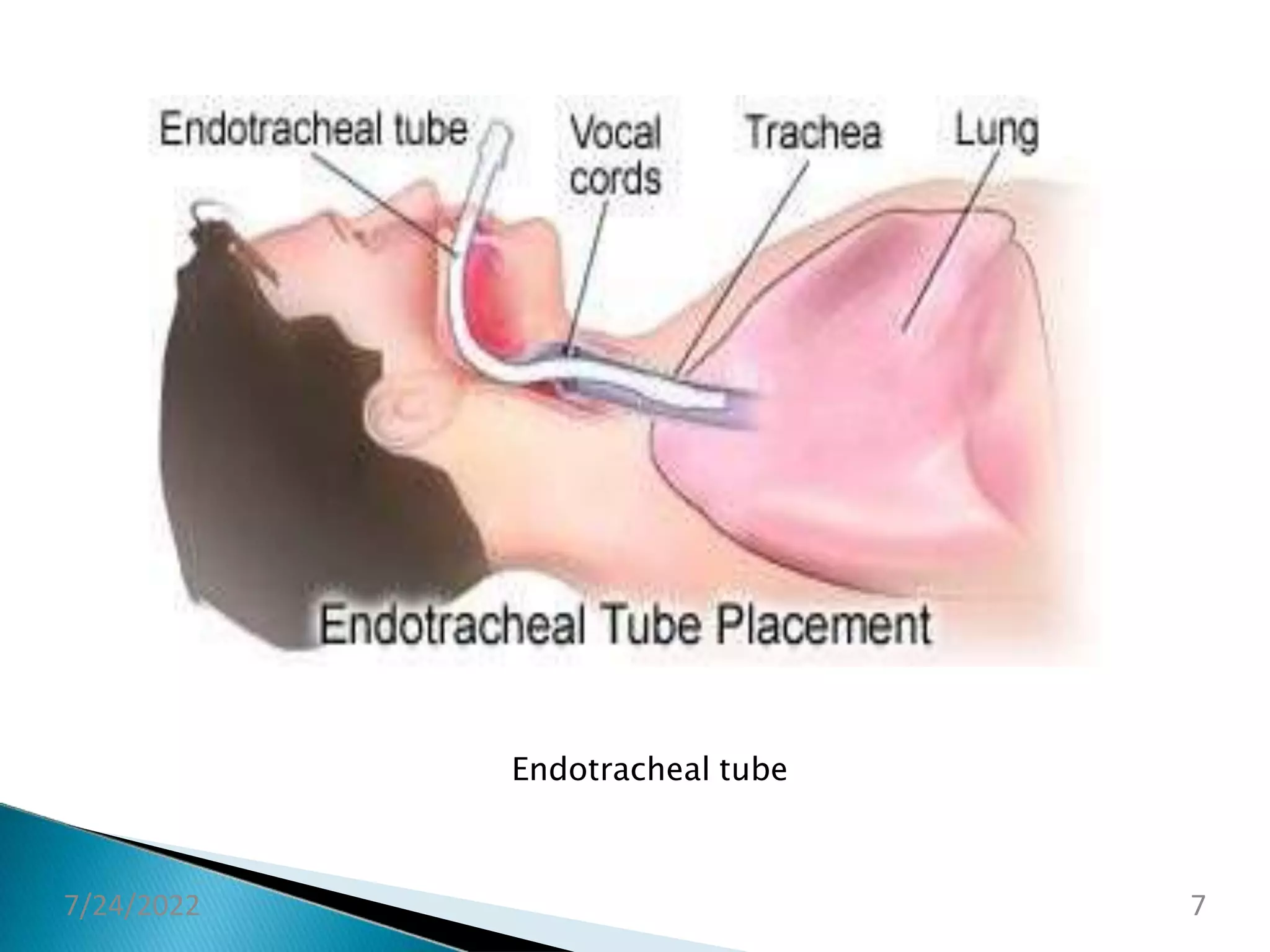 ET TUBE intubation | PPTX