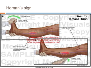 Pulmonary Embolism | PPTX