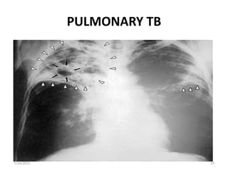 PULMONARY TB
7/24/2022 19
 