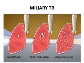 MILIARY TB
7/24/2022 20
 