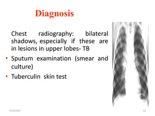 Diagnosis
Chest radiography: bilateral
shadows, especially if these are
in lesions in upper lobes- TB
• Sputum examination (smear and
culture)
• Tuberculin skin test
42
7/24/2022
 