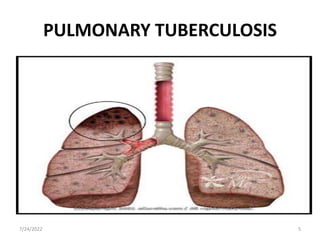 PULMONARY TUBERCULOSIS
7/24/2022 5
 