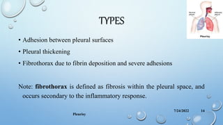 TYPES
• Adhesion between pleural surfaces
• Pleural thickening
• Fibrothorax due to fibrin deposition and severe adhesions
Note: fibrothorax is defined as fibrosis within the pleural space, and
occurs secondary to the inflammatory response.
7/24/2022
Pleurisy
14
 