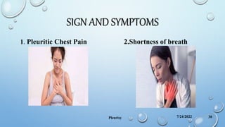 SIGN AND SYMPTOMS
1. Pleuritic Chest Pain 2.Shortness of breath
7/24/2022
Pleurisy 30
 