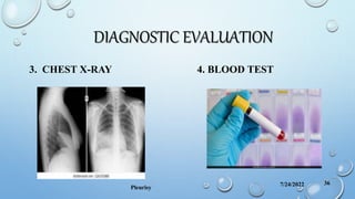 DIAGNOSTIC EVALUATION
3. CHEST X-RAY 4. BLOOD TEST
7/24/2022
Pleurisy
36
 