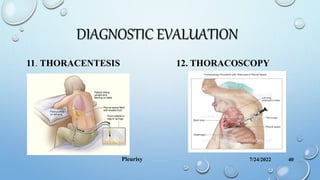 DIAGNOSTIC EVALUATION
11. THORACENTESIS 12. THORACOSCOPY
.
7/24/2022
Pleurisy 40
 