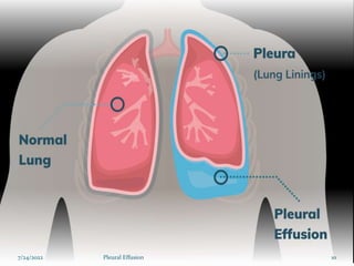 7/24/2022 10
Pleural Effusion
 