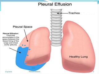 7/24/2022 11
Pleural Effusion
 