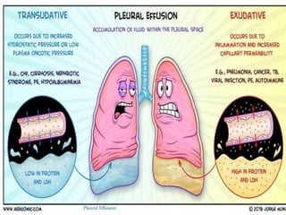 7/24/2022 20
Pleural Effusion
 